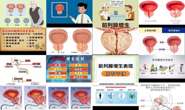 汕头前列腺增生的症状