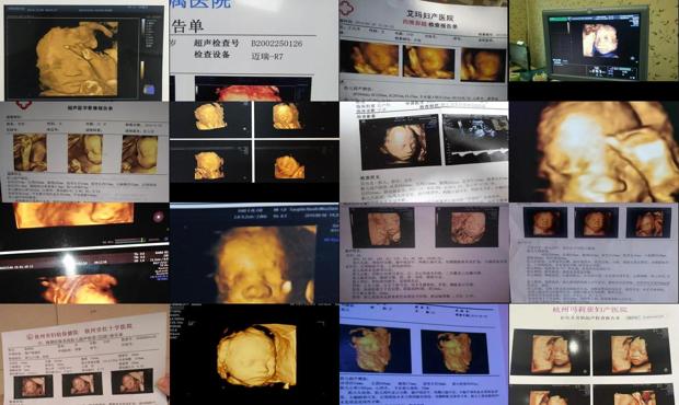汕头6个月胎儿四维彩超