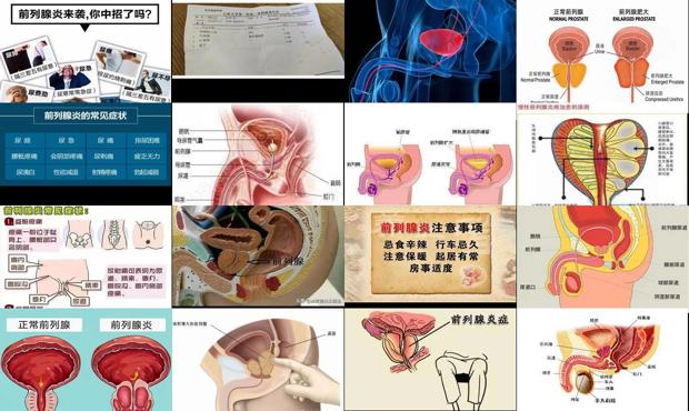 汕头如何判断自己前列腺炎