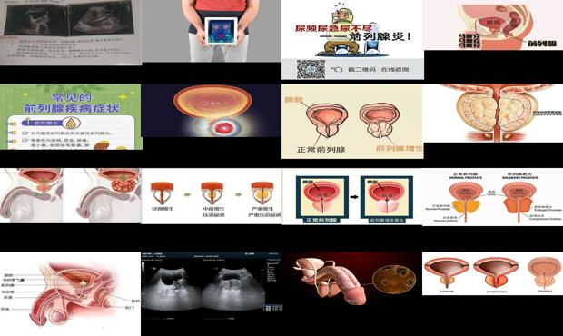 汕头前列腺增大