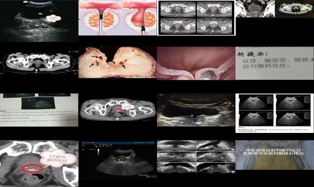 汕头前列腺钙化灶
