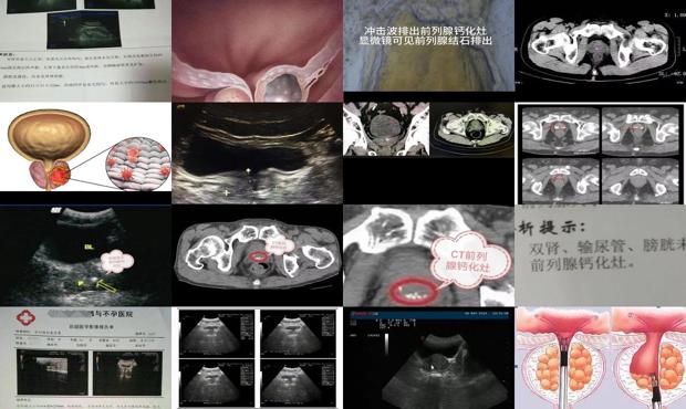 汕头前列腺钙化灶是什么意思