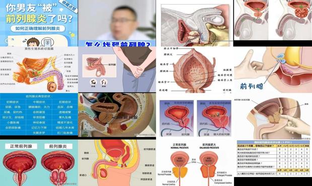 汕头前列腺怎么判断