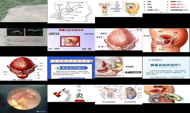 汕头前列腺精囊炎
