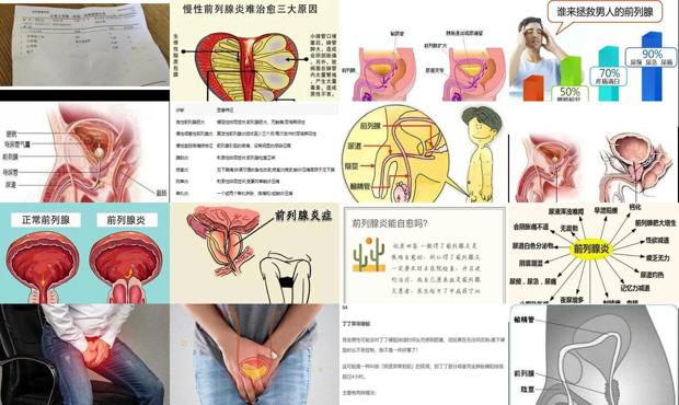 汕头前列腺炎如何自愈