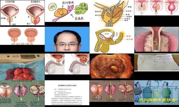 汕头前列腺肥大的