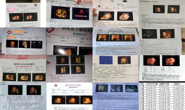 汕头四维彩超检查表