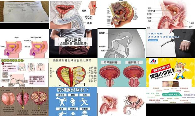 汕头前列腺炎早射