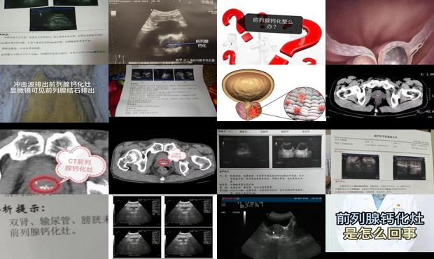 汕头前列腺钙化灶是啥意思