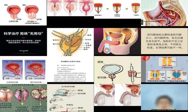 汕头前列腺肥大是怎么得的