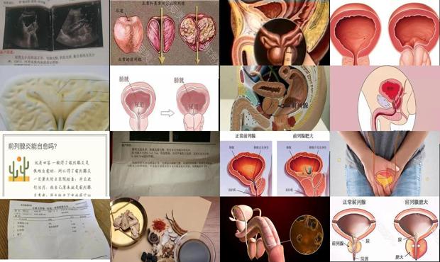 汕头前列腺增大可以自愈吗