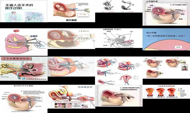 汕头*人流手术过程图解