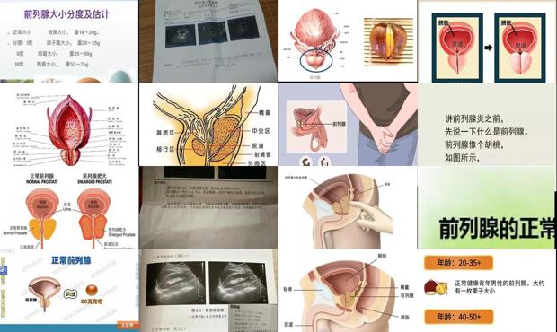 汕头前列腺大小