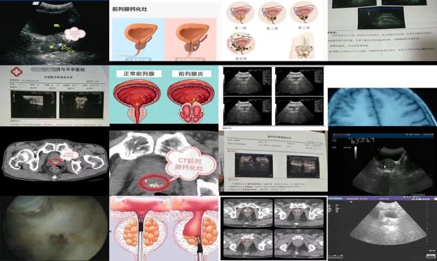 汕头前列腺钙化灶的症状