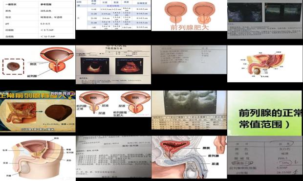 汕头前列腺正常是多少mm