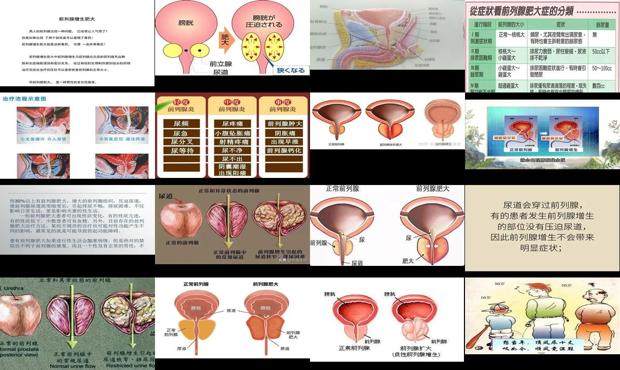 汕头造成前列腺肥大的原因