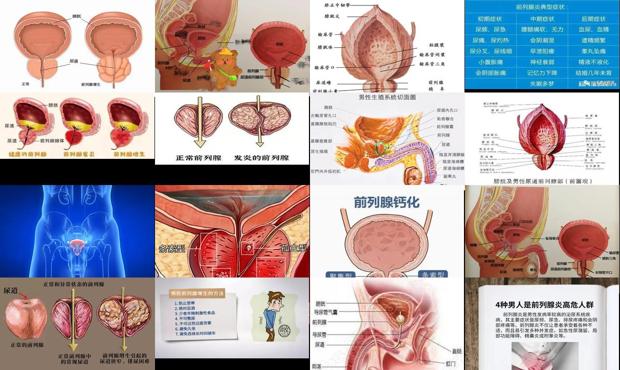 汕头前列腺是什么病状