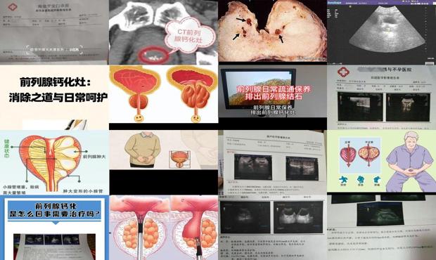 汕头前列腺钙化灶怎么治疗