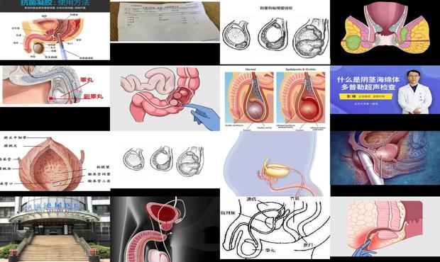 汕头前列腺硬结