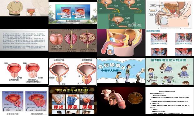 汕头前列腺肥大怎么造成的