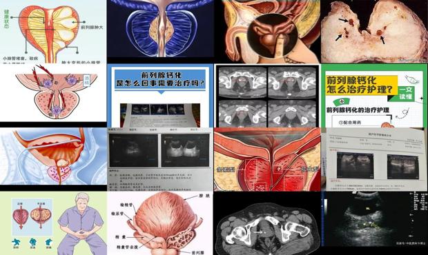 汕头前列腺钙化什么意思