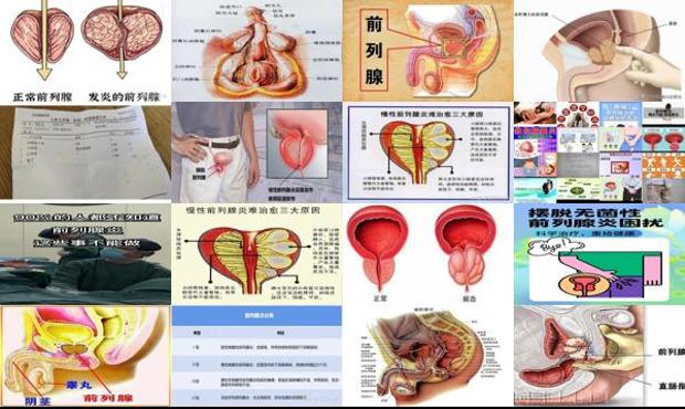 汕头无菌性前列腺炎