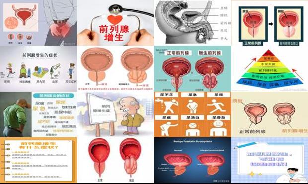 汕头前列腺增生主要症状