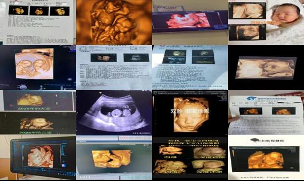 汕头四维彩超双胞胎