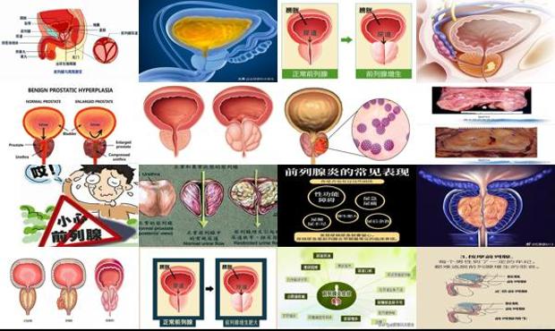 汕头前列腺增生肥大