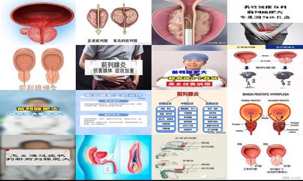 汕头前列腺肥大有什么症状